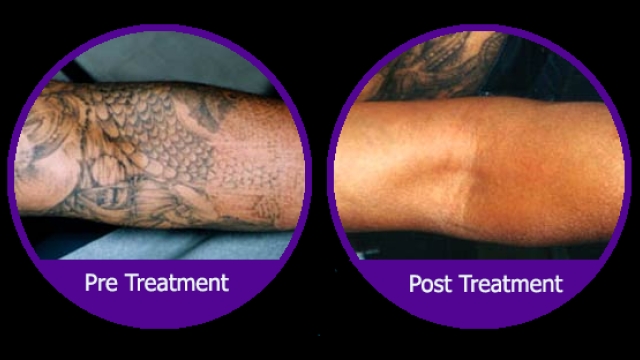 Tattoo Removal Costs – Finding An Economical Way Remove Your Tattoo