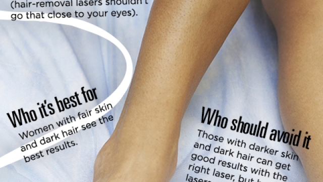 Laser Hair Removal: Unveiling the Smooth Evolution