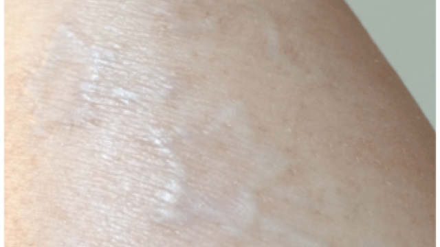 Laser Tattoo Removal Cost – Is This Worth Things?