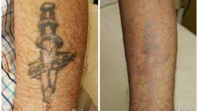 Tca Tattoo Removal – Ideal For Removing Leg Tattoos