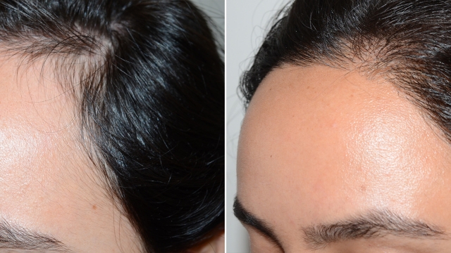 Unlock a Luxurious Mane: Revamp Your Look with Hair Implants!