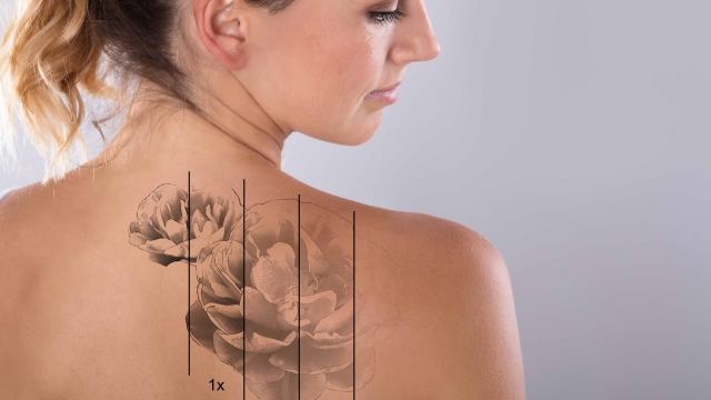 Tattoo Removal: Options Obtaining That Tattoo You Regret Removed