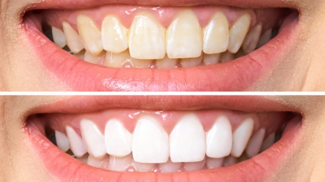 Unveiling Picture-Perfect Smiles: The Magic of Crest Whitening Strips