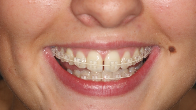 Unmasking the Art of Orthodontics: A Smile Journey