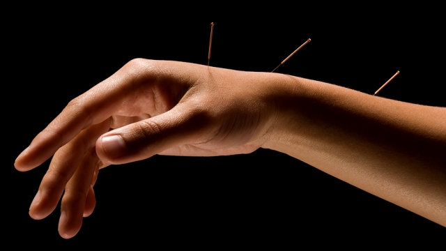 Unlocking the Power of Acupuncture: Ancient Healing for Modern Wellness